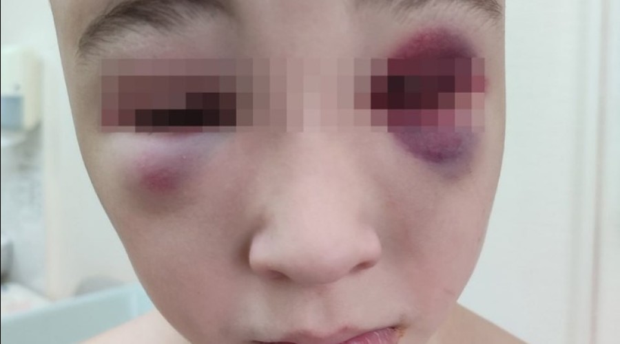 Россиянка обвинила участника спецоперации в избиении 10-летнего сына палками